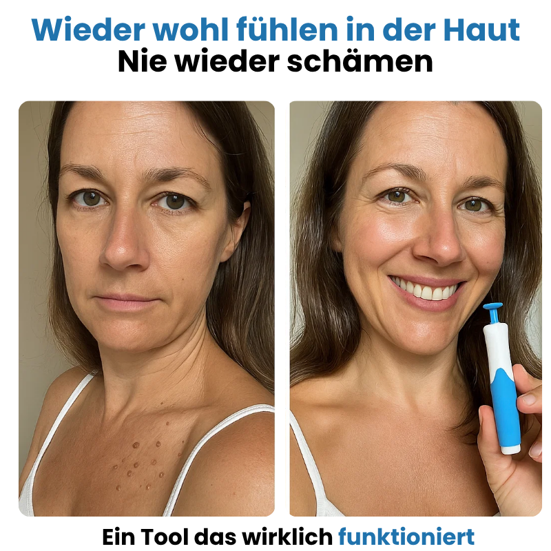ALCURA™ Komplett Set - Nie wieder Hautanhängsel