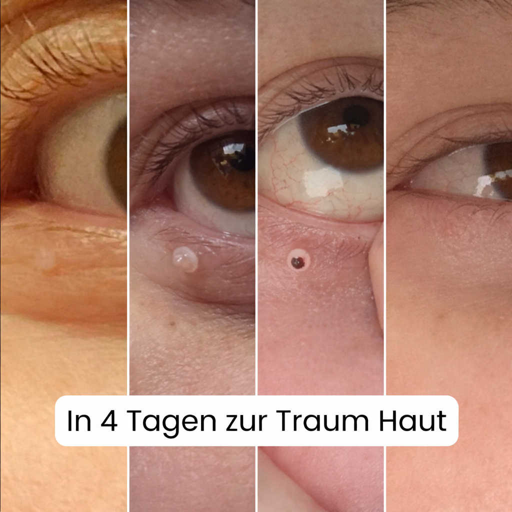 ALCURA™ - Glatte Haut in nur 4 Tagen