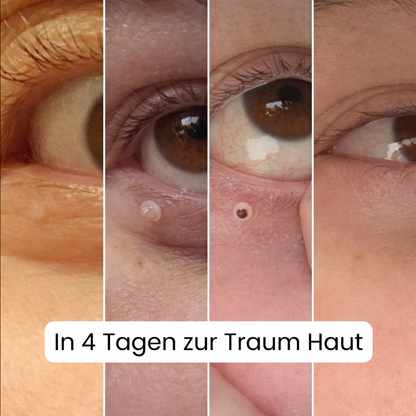 ALCURA™ - Glatte Haut in nur 4 Tagen