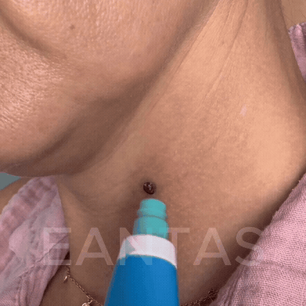 ALCURA™ - Glatte Haut in nur 4 Tagen