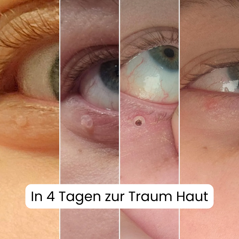 ALCURA™ Komplett Set - Nie wieder Hautanhängsel