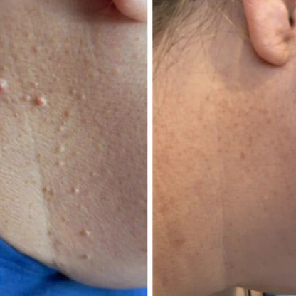 ALCURA™ - Glatte Haut in nur 4 Tagen